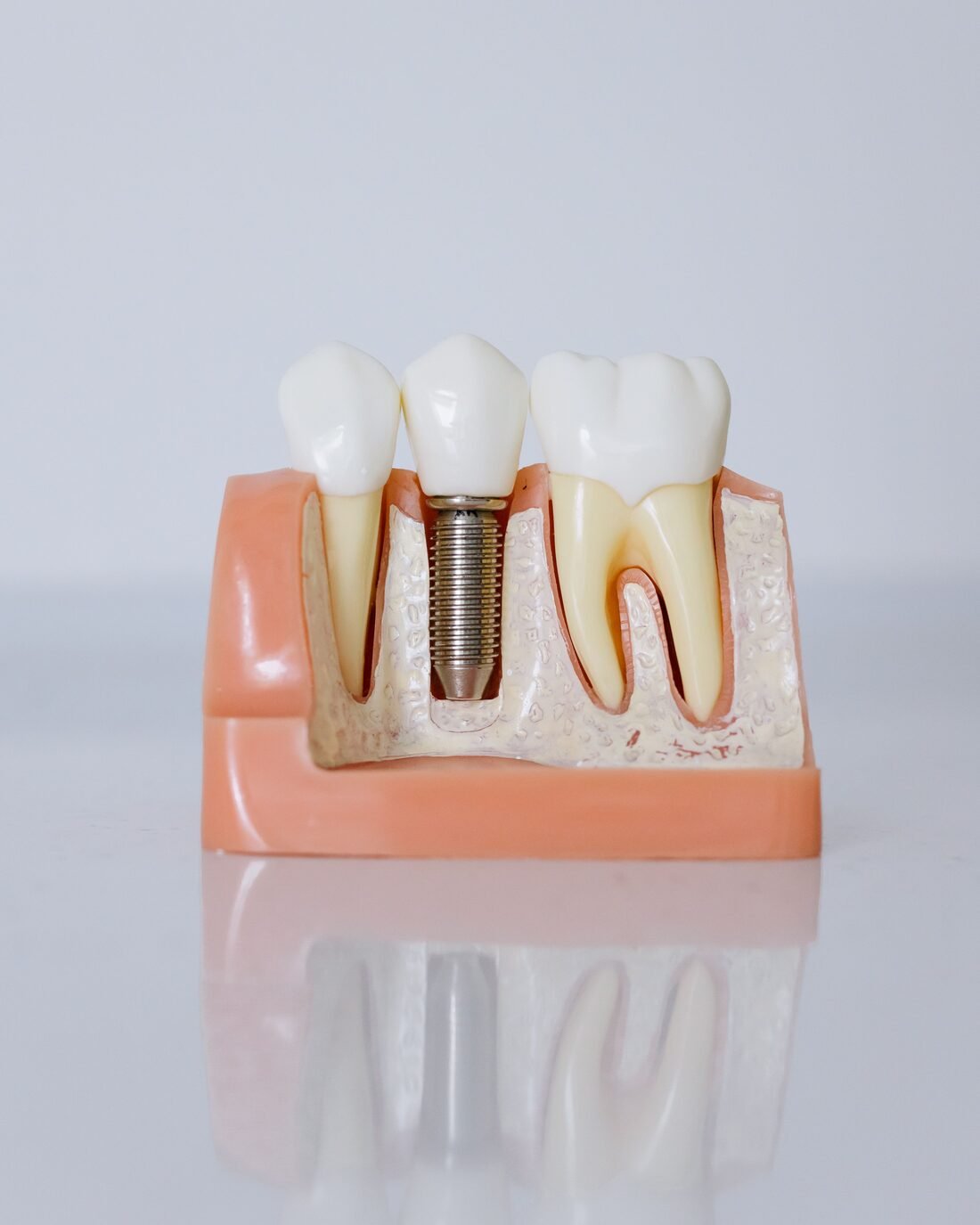 Modell eines Implantats im Kieferquerschnitt neben zwei natürlichen Zähnen