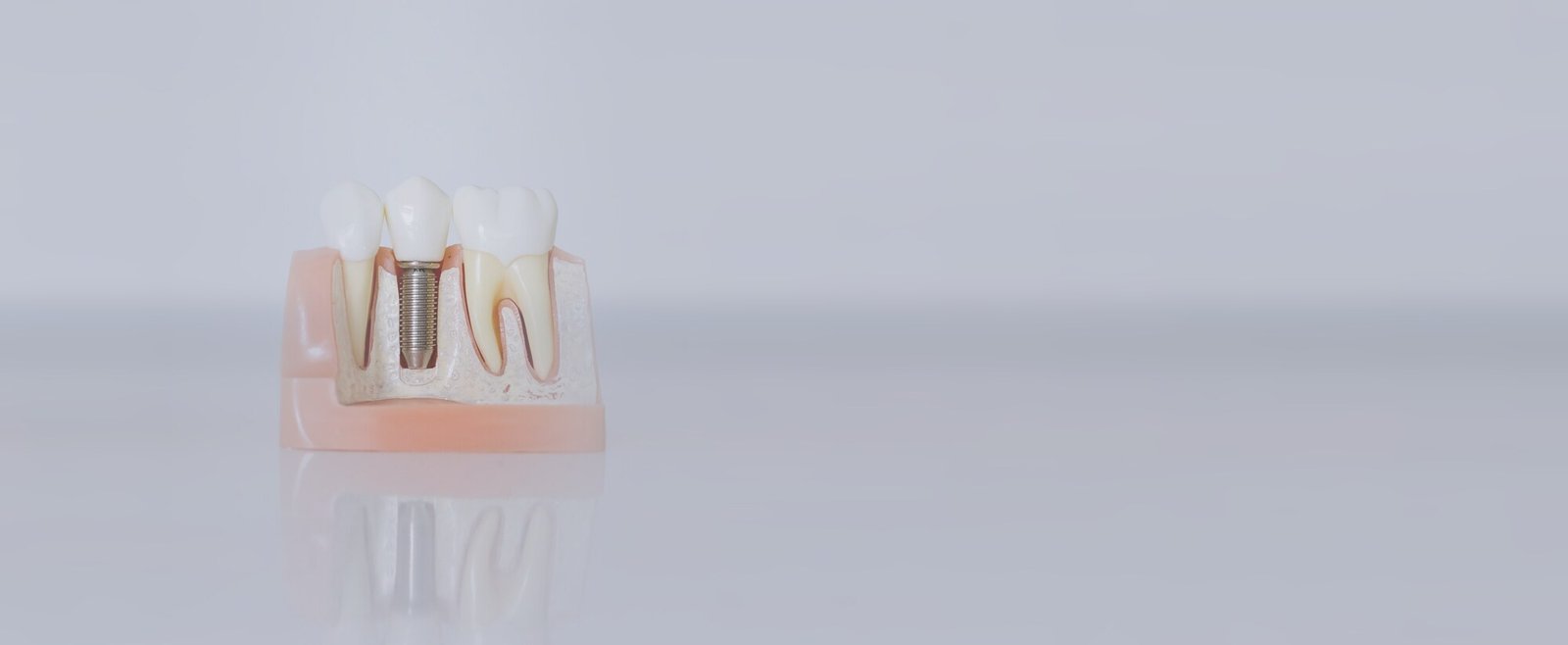 Modell eines Implantats im Kieferquerschnitt neben zwei natürlichen Zähnen